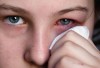 Cẩn thận với bệnh viêm kết mạc mùa đông xuân