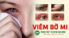 Viêm bờ mi và những điều bạn chưa biết
