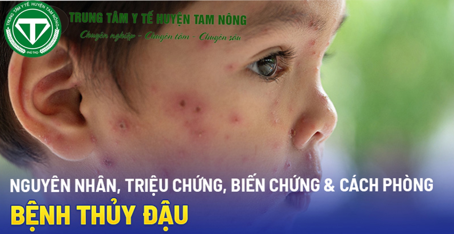 thủy đậu